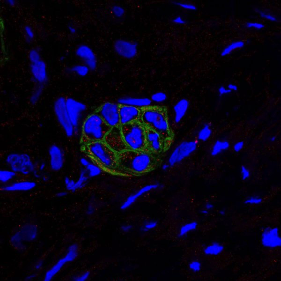 Human PDAC tumors shows co-expression of CXCL1 (red) and CK19 (green; a marker of PADC) by confocal microscopy.